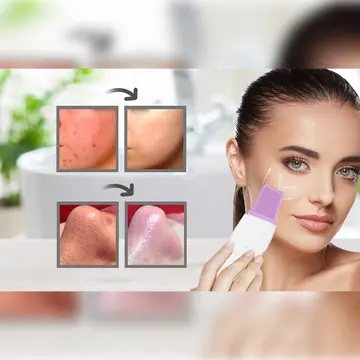 Ultrasonıc Siyah Nokta  Akne Spatula Şarjlı Cilt Temizleyici